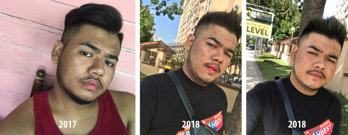 Airiey lost weight but still have bad skin after trying many products and supplements.